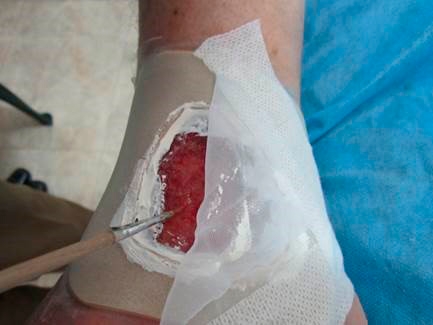 Substância produzida por larvas de mosca pode curar feridas crônicas